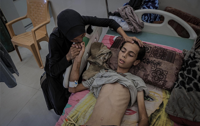 Zdroj: Internet milliyet.com.tr Podvyživené dítě v nemocnici v Gaze, oběť humanitární krize a blokády pomoci – Gaza hladoví